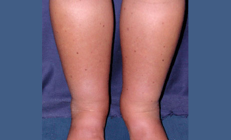 edema