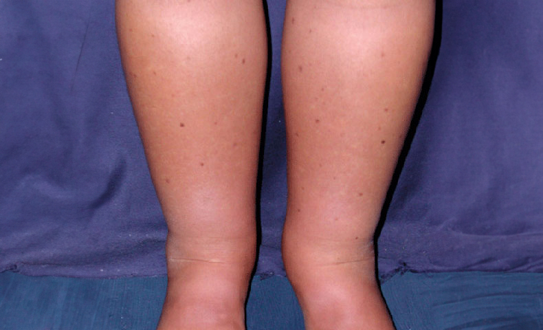 edema le c.d. gambe gonfie
