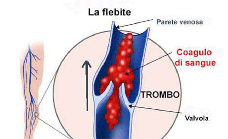 flebite